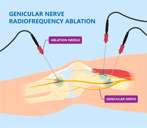 Stop blood thinning medication 2 days prior to the test . . Nerve block test before radiofrequency ablation
